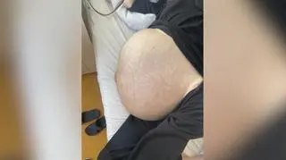 Guz ważył około 20 kilogramów