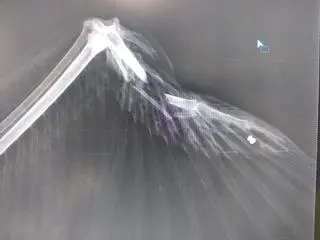 Na zdjęciu rentgenowskim widać śrut w skrzydle