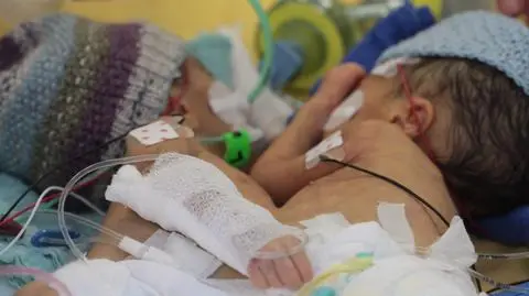 Najmniejsze bliźnięta syjamskie rozdzielone. "Byliśmy przygotowani na śmierć"