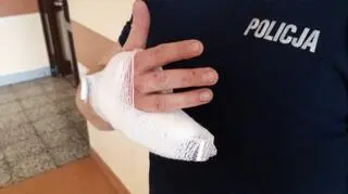 Kierowca odgryzł policjantowi część małego palca prawej dłoni