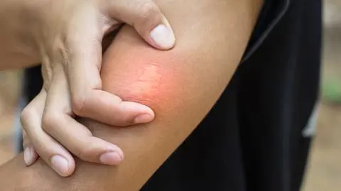 Alergia na jad owadów