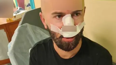 Uderzył w słupek na ścieżce. "Rower został, ja poleciałem na twarz"