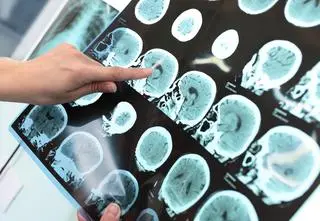Choroba Alzheimera wywołana przez terapię z dzieciństwa?