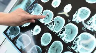 Dźwięki i migoczące światło mogą pomóc chorym na alzheimera 
