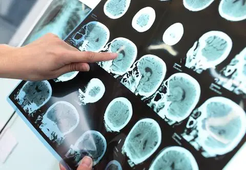 Choroba Alzheimera wywołana przez terapię z dzieciństwa?