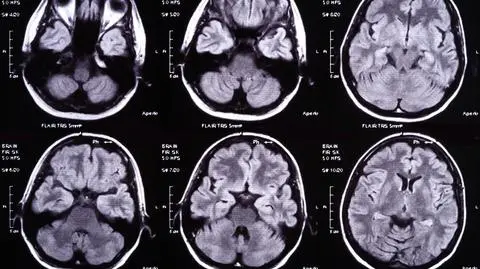 80 procent hospitalizowanych z powodu COVID-19 z problemami neurologicznymi