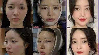 Patient Recovery_Facial Contour
