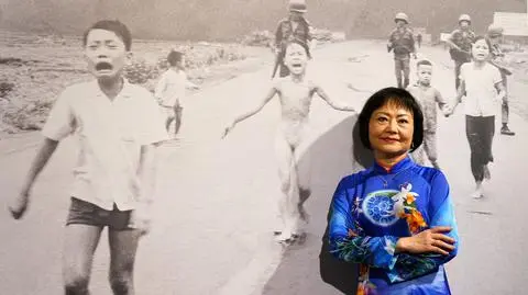 Blizny odparowane laserem. Po 50 latach "Napalm Girl" ma szanse na koniec cierpienia