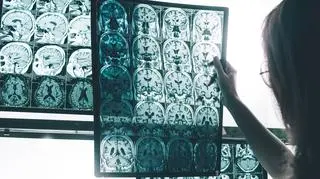 Nowa terapia dla chorych na Alzheimera. Wkrótce badania w Polsce