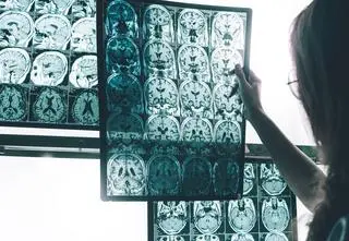 Nowa terapia dla chorych na Alzheimera. Wkrótce badania w Polsce
