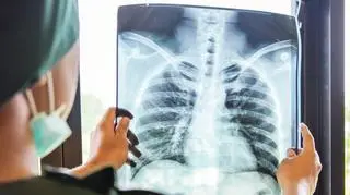 Ta choroba zakaźna zabiła najwięcej ludzi
