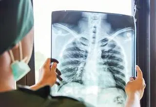Gruźlica w żłobku i przedszkolu. Ponad 170 osób pod obserwacją