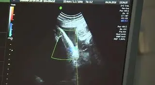 Badania prenatalne pozwalają ustalić, czy dziecko w łonie matki jest zdrowe