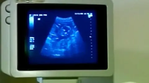 Najpiew zobacz płód, potem usuń ciążę