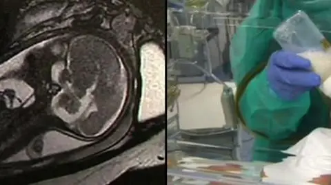 Historyczna operacja. Usunęli chłopcu guz, zanim się urodził