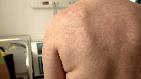 Lawinowy wzrost zachorowań na odrę w Europie