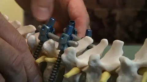 Wkręcenie śrub w kręgosłup, cztery dni i do domu