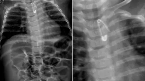 Dziecko połknęło agrafkę. Śledztwo prokuratury regionalnej w Łodzi