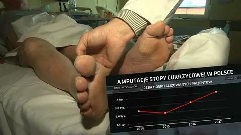 Coraz więcej amputacji z powodu stopy cukrzycowej