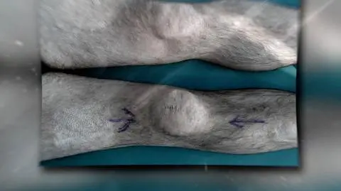Polish doctors completed a groundbreaking kneecap transplant
