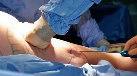 Chirurg z Warszawy odmówił Annie zabiegu liposukcji