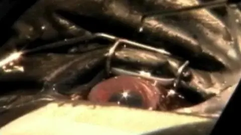 Operacja na gorylich oczach