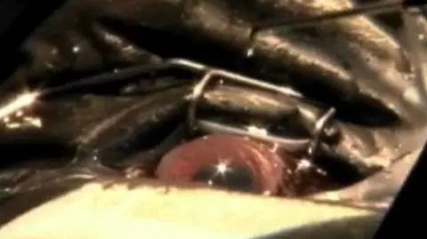 Operacja na gorylich oczach