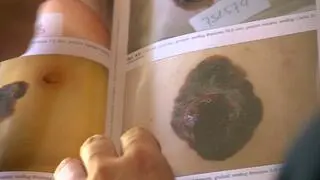 Immunoterapia okazała się skuteczna w walce z czerniakiem