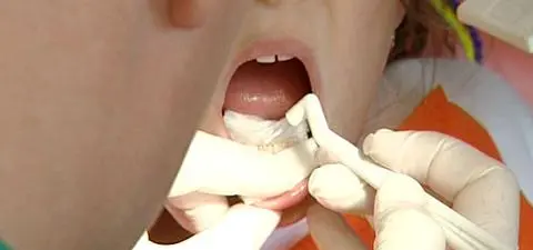 Próchnica to nie tylko choroba zębów. "Dzieci trafiają na intensywną terapię"