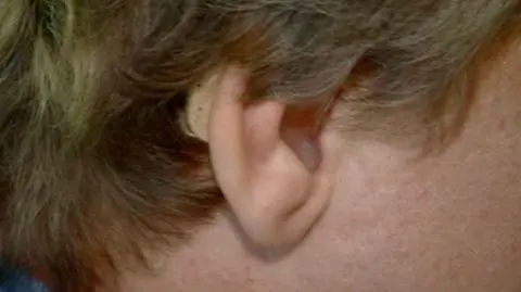 Przełom w medycynie. Implant słuchu jak most