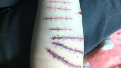 Plaga samookaleczeń w szpitalu psychiatrycznym