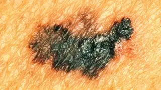 Czerniak stanowi największe zagrożenie