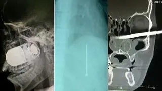 Chirurdzy wyjęli granat z twarzy żołnierza