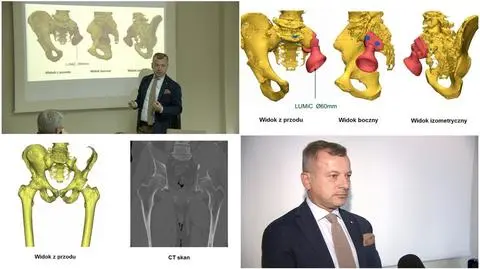 Poznańska operacja miednicy z użyciem technologii druku 3D