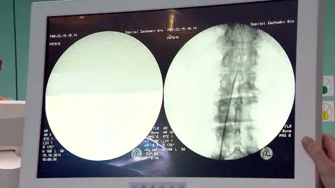 Lekarze wszczepili chorym elektrody