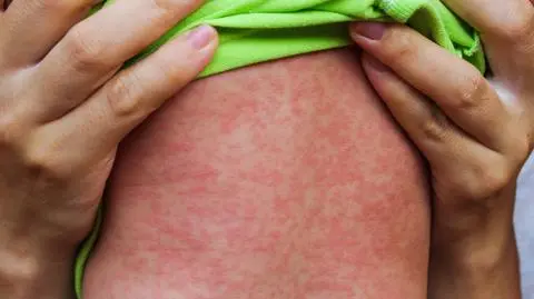 Rośnie zagrożenie odrą. Na nagraniu "Polska i Świat" z 3 kwietnia