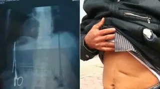 Chirurdzy wyjęli nożyczki w czasie 3-godzinnej operacji 