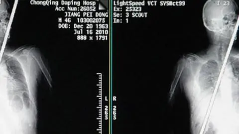 Pręt przeszył go na pół. Przeżył