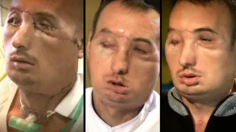 Pół roku po przeszczepie twarzy. "Dostałem drugie życie. Nie oczekuje niczego więcej"