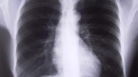 Kolejny przypadek gruźlicy w Poznaniu