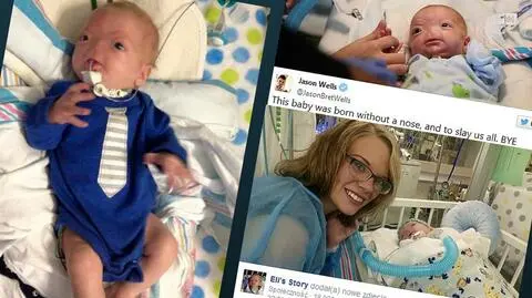Eli urodził się bez nosa. Chłopiec choruje na arhinię