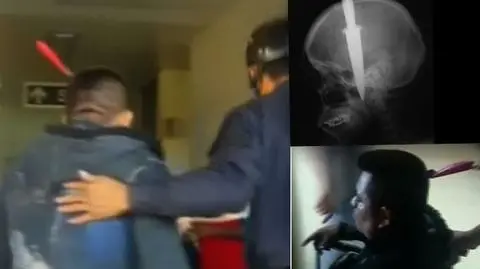 Peruwiańczyk przyszedł do lekarza z nożem w głowie