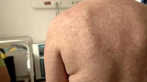 Measles breakout in the environs of Warsaw. So far, 18 people were affected