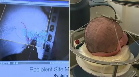 Przeszczepia włosy najprecyzyjniej na świecie