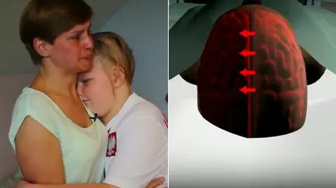 Operacja szansą na normlaność. Odetną 10-latce lewą półkulę mózgu