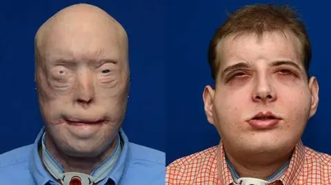 Strażak dostał nową twarz