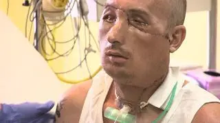 Pacjent bez przeszczepu twarzy, nie miał szans na życie 