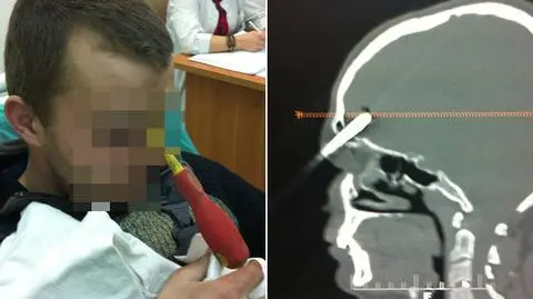 Szczęście w nieszczęściu. Śrubokręt w głowie