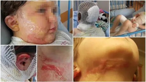 Przedszkolanka przypadkiem wylała na Magdę wrzątek