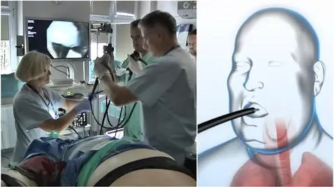 Takiej operacji w Polsce jeszcze nie było. Żołądek zmniejszali przez usta